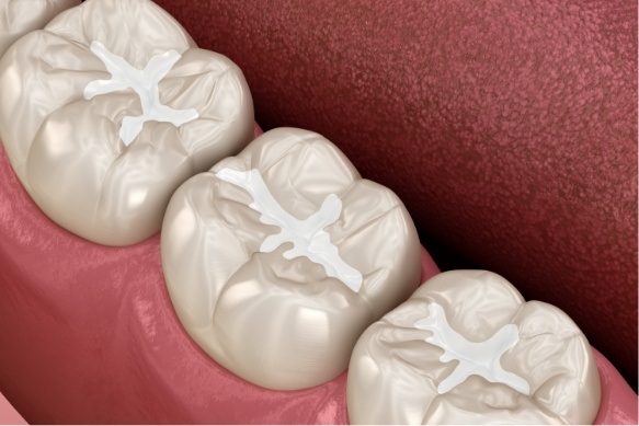 Animated smile with tooth colored fillings