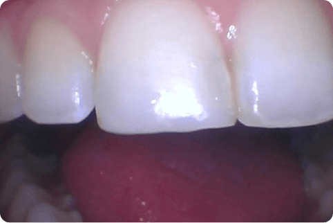 Smile after chipped top front tooth is repaired