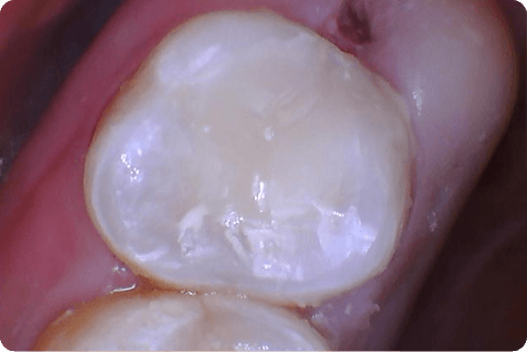 Smile repaired seamlessly with tooth colored fillings
