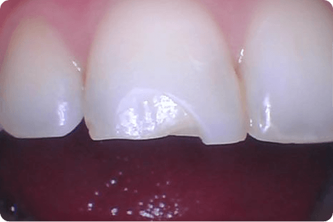 Smile with chipped top front tooth