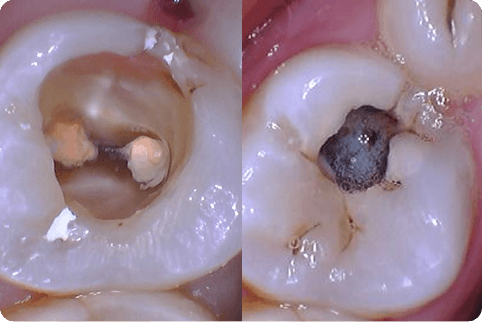 Smile with decay and dark fillings