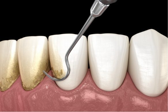 Animated smile during scaling and root planing gum disease treatment