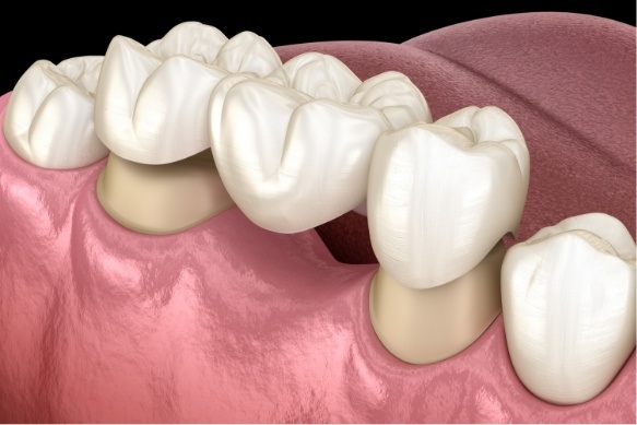 Animated smile with dental bridge replacing missing teeth